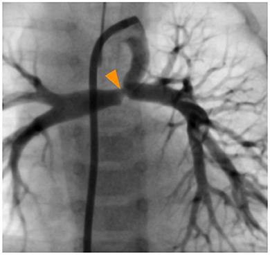 Case report: Right atrial appendage hybrid access to bailout a stuck stent from the inferior vena cava of a small child